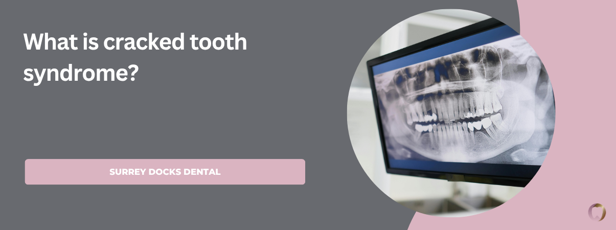What is cracked tooth syndrome?